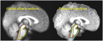 Neuroinflammation and Cytokines in Myalgic Encephalomyelitis/Chronic Fatigue Syndrome (ME/CFS): A Critical Review of Research Methods